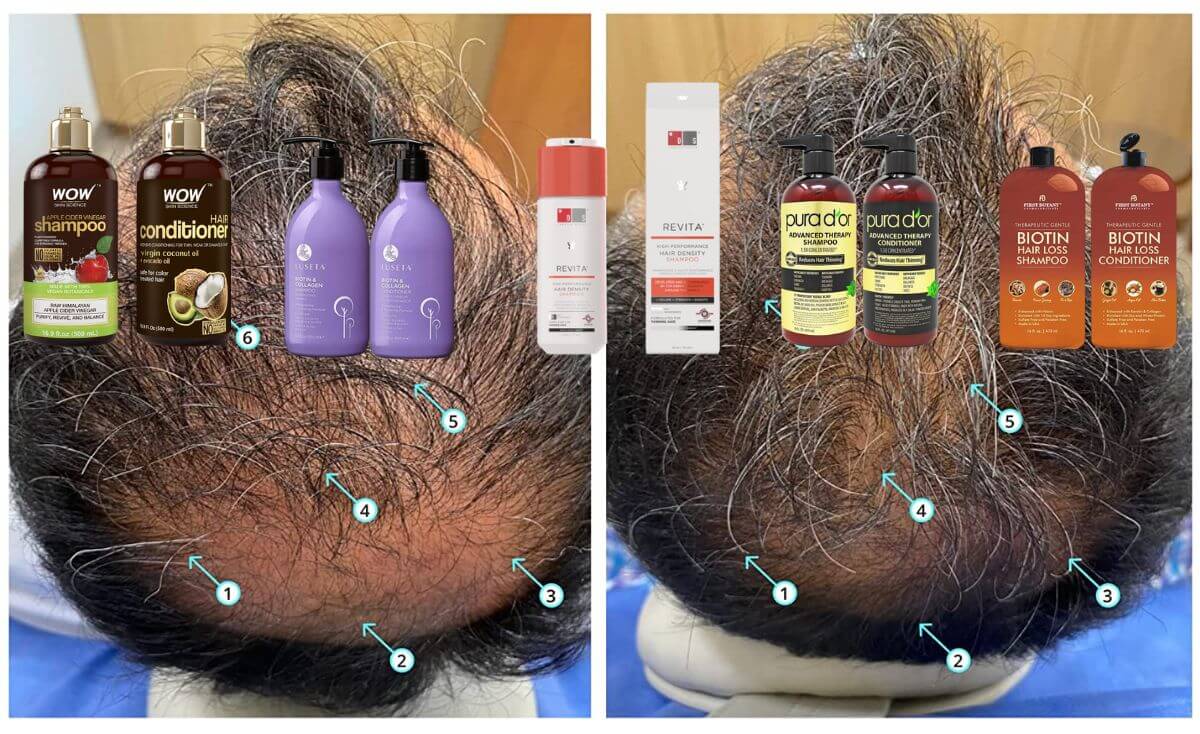 Keep Your Newly Grown Hair Luscious and Healthy Top 5 Shampoos for PostTransplant Care